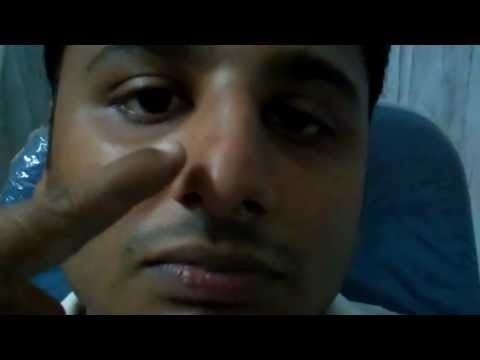 Handsome face but not handsome nose:Rhinoplasty in India