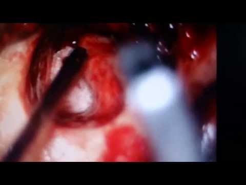 Harvesting Pearl from the Ear:Cholesteatoma Surgery