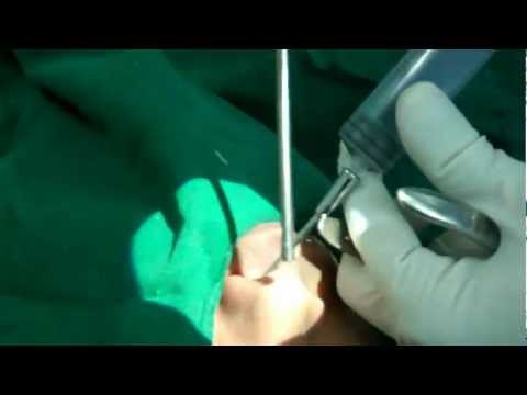 Headache and Nose Bleed After Flying