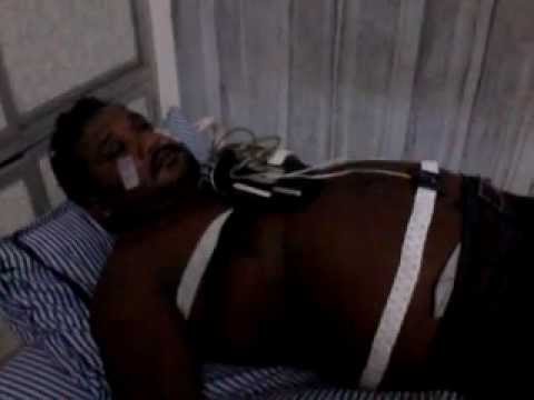 Home Sleep Study in OSA Patient