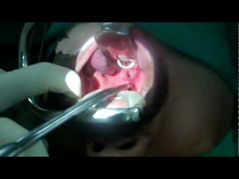 How the Throat Look like in Snoring and Sleep Apnea