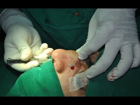 How To Break Nasal Bones ?