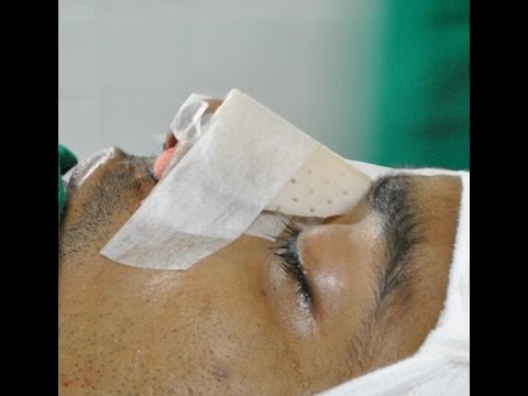 How to Correct a Saddle Nose Deformity of Nose?