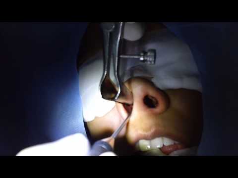How to Cure Excessive Sneezing by Laser and Coblator