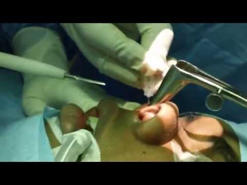 How to Cure Nasal Blockage