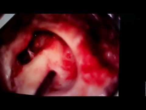 How to do revision mastoidectomy