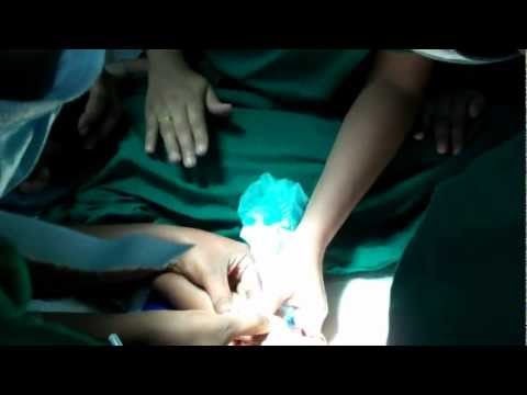 How to Put a Drip for a child:Difficult way