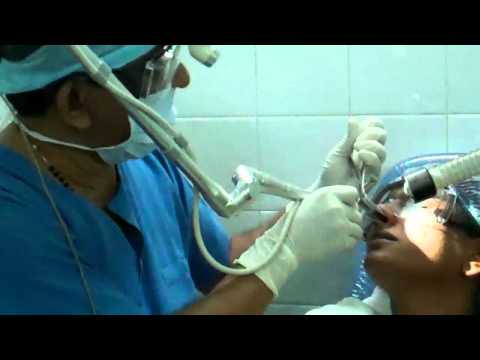 How to stop Sneezing by doing laser cautery?