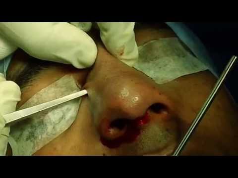 How to Straighten a Crooked Nose?