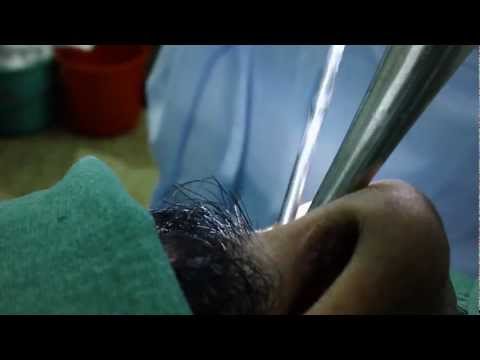 Huge Nasal Polyps Removed