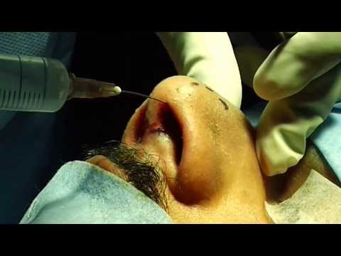 Indian Rhinoplasty Then and Today