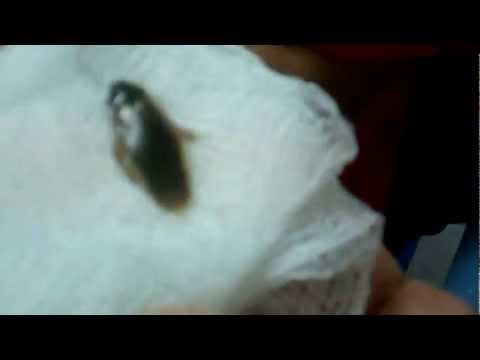 Insect (Cockroach) in the Ear:What will you do?