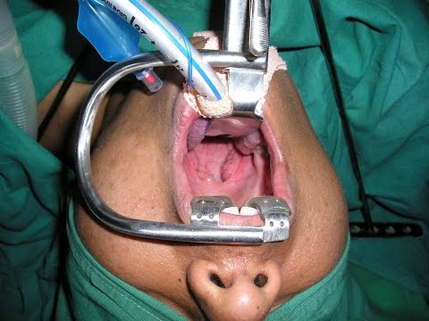 Is Tonsillectomy worth in Adults?