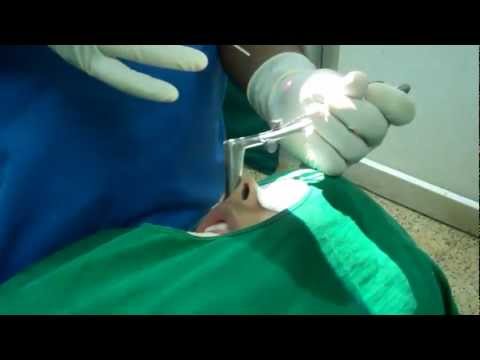 Jasmine gets her Sinus cleaned and Laser Nose