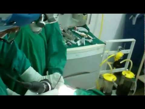 Killian”s AntroChoanal Polyp