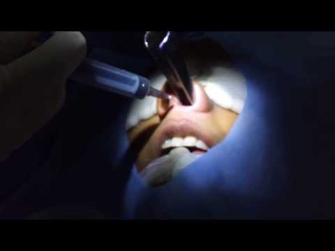 Lady Doctor undergoes Surgery for Nasal Allergy