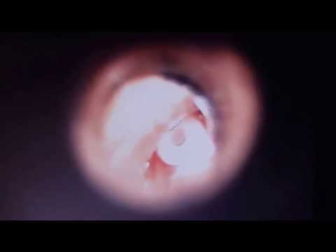 Lakshmy Gets Ear Tubes Placed