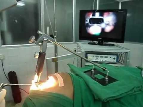 Laryngeal Cancer Biopsy.