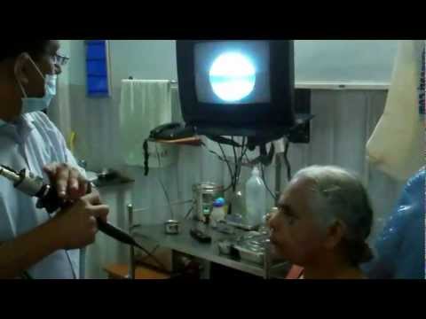 Laryngocele in old lady