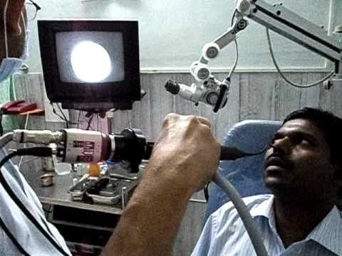 Laryngoscopy-2- in Jubilee Hospital, Trivandrum.