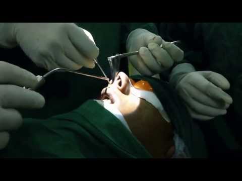 Laser Septoplasty and Laser Mucotomy