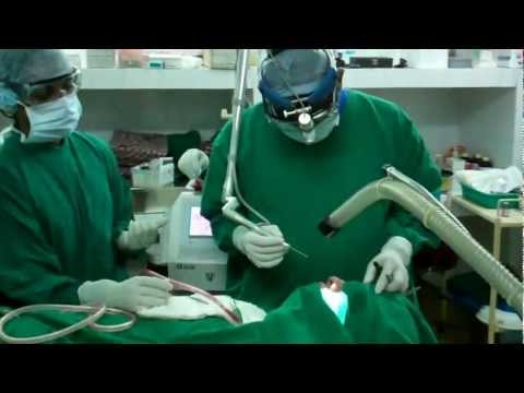 Laser Septoplasty as part of Nasal Surgery