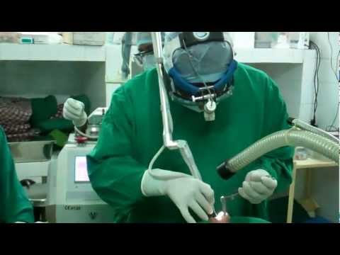 Laser Septoplasty:Jubilee Hospital Trivandrum, India