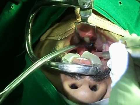 Laser Surgery For Snoring and OSA in Jubilee Hospital Trivandrum, India