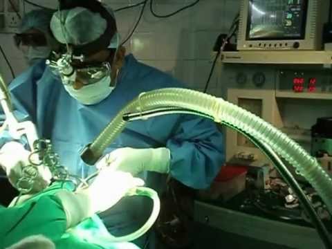 Laser Surgery for Snoring and Sleep Apnea-Complications.AVI