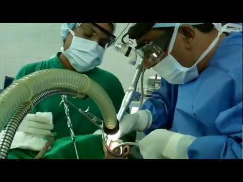 Laser Surgery For Snoring and Sleep Apnea in India:Complications