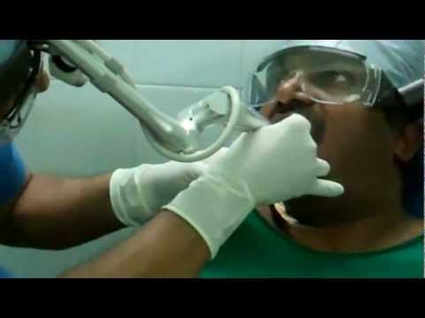Laser surgery for Snoring and Sleep Apnea:LAUP