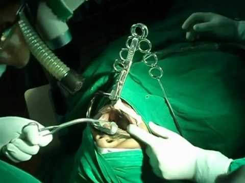 Laser Surgery For Snoring and Sleep Apnea