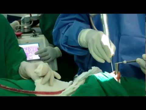 Laser Surgery For Snoring by CO2 Laser