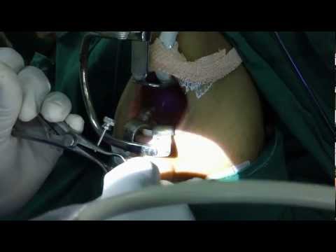 Laser Surgery of Nose for Dr.Savitha