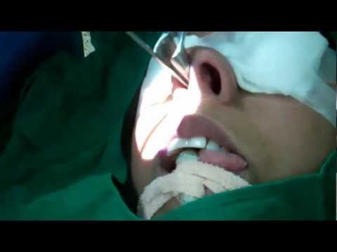 Laser Surgery of Nose under GA