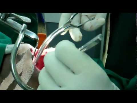 Laser Surgery of Throat