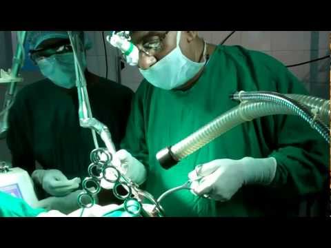 Laser Surgery to Cure Snoring and Sleep apnea: How it is Performed?