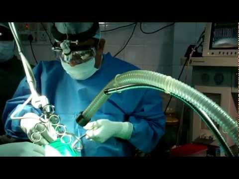 Laser Tonsillectomy:Snoring and OSA