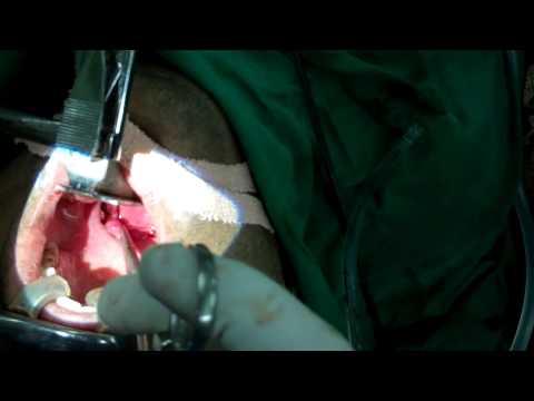Laser Treatment of Granular Pharyngitis