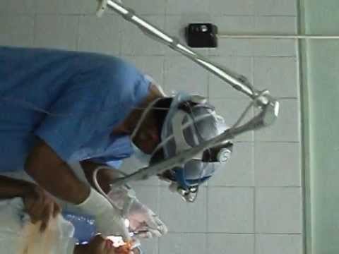 Laser Turubinectomy part 3.AVI