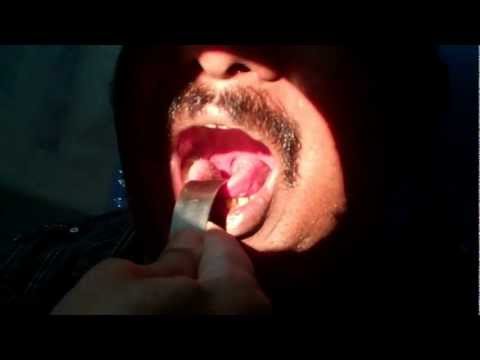 Loud Snorer:Cynosed:Dr.K.O.Paulose FRCS