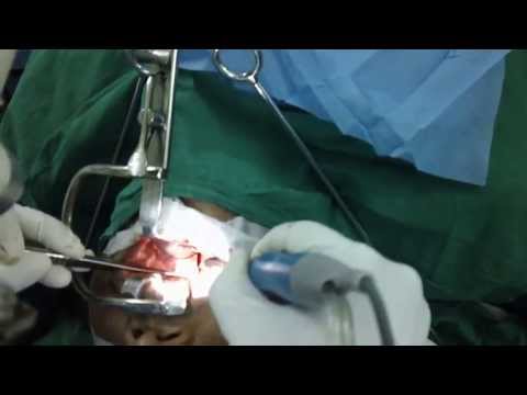 Loud Snoring and Severe Sleep Apnea: Tonsillectomy and Uvuloplasty