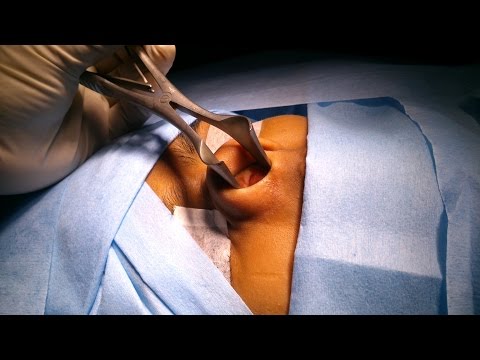 Maldivian Girl Undergoes Nose Surgery in India