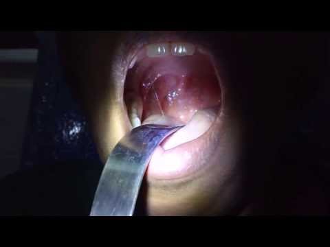 Managing Chronic Sore Throat:Laser Cautery