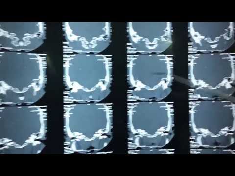 Mastoid Ear Surgery in Jubilee Hospital Trivandrum Kerala India