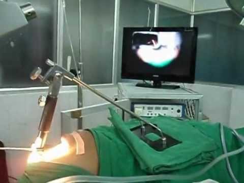 Micro Surgery of Larynx .