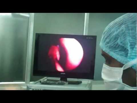 Microdebrider Assisted Turbinoplasty