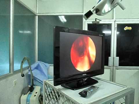 Microdebrider in Otorhinolaryngology in India