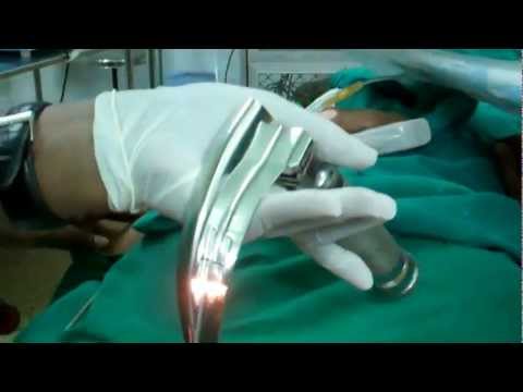 Microlaryngeal Surgery:Anesthesia Part