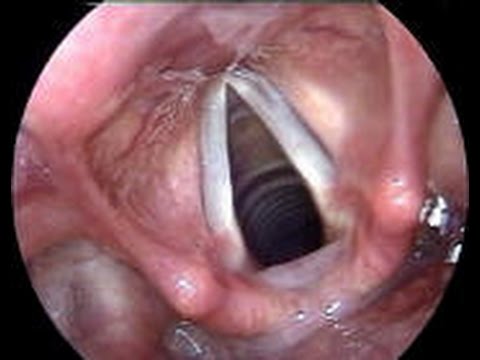 Microlaryngeal Surgery-GA Intubation